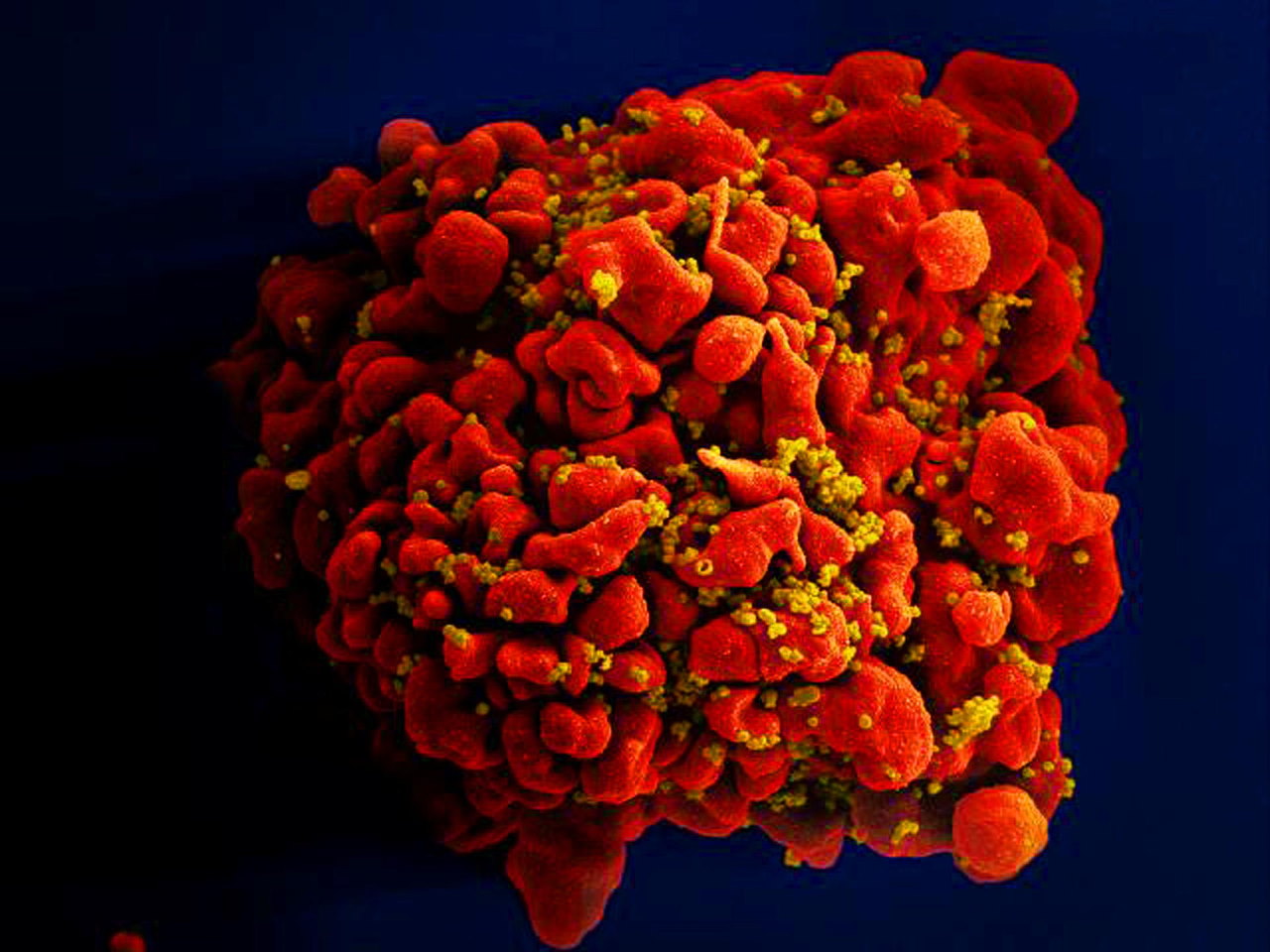 Отримане за допомогою електронного сканувального мікроскопа зображення Т-клітини (червона), інфікованої ВІЛ (жовті). NIAID