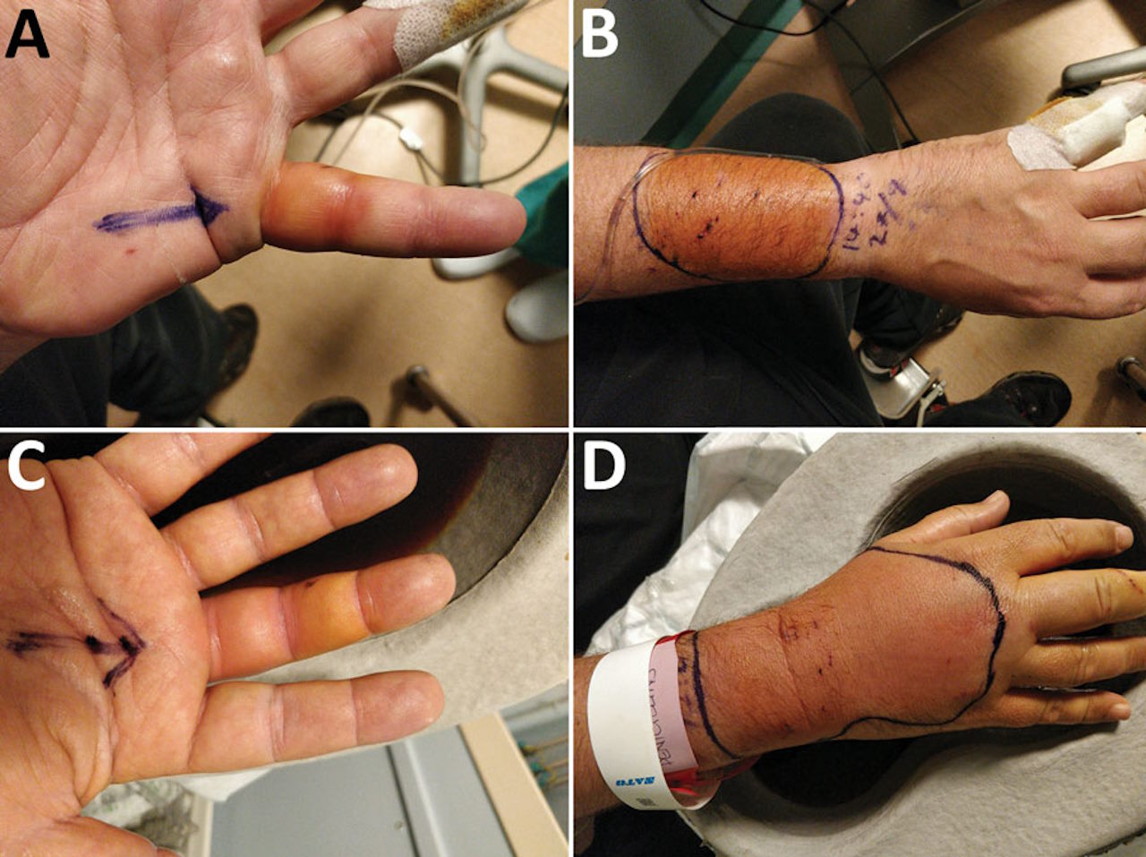 Осередки інфекції на руці чоловіка після укусів кота.&amp;nbsp;Jones et al. / Emerging Infectious Diseases, 2023