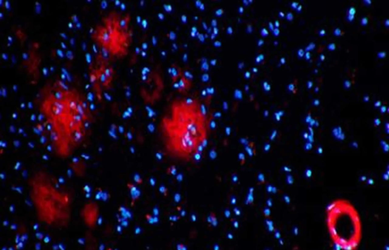 Мікрофотографія мозкової тканини людини з хворобою Альцгеймера. Червоним позначено амілоїдні бляшки, синім — ядра клітин. Dr. Matthew Campbell / Neuroscience News
