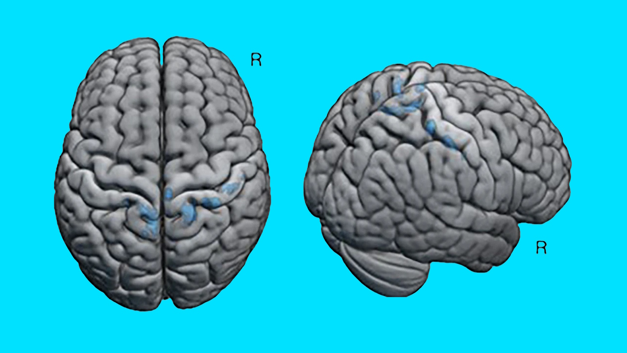 Ділянки мозку астронавток, довкола яких відмітили сильніше зменшення об'єму рідини, ніж у їхніх колег-чоловіків (зафарбовані блакитним). McGregor et al. / npj Microgravity, 2025