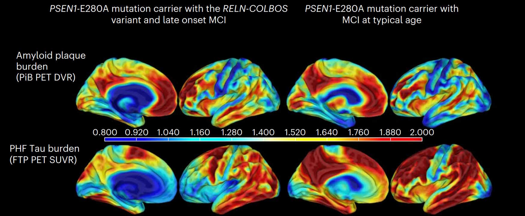Кількість патологічних бета-амілоїду (зверху) та тау-білка (знизу) у мозку пацієнта з новим варіантом&amp;nbsp;RELN (зліва) та у типового носія гену спадкової хвороби Альцгеймера з настанням деменції у ранньому віці (справа).&amp;nbsp;Francisco Lopera et al. /&amp;nbsp;Nature Medicine, 2023