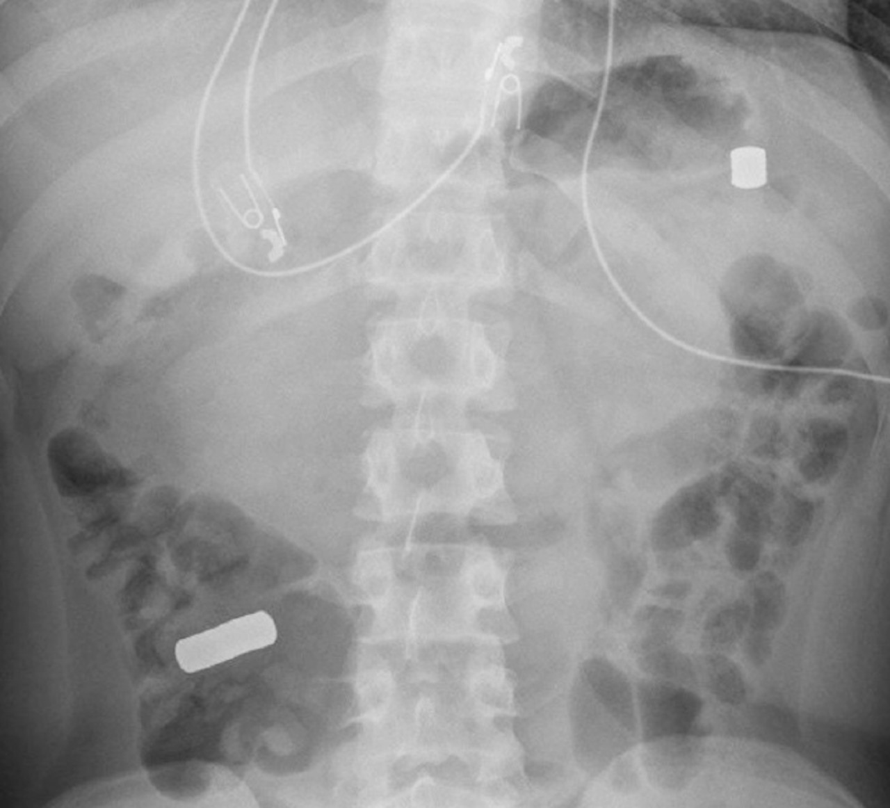 Рентген пацієнта, що проковтнув металеві предмети.&amp;nbsp;Maksimyan et al. / BMJ Case Reports, 2023