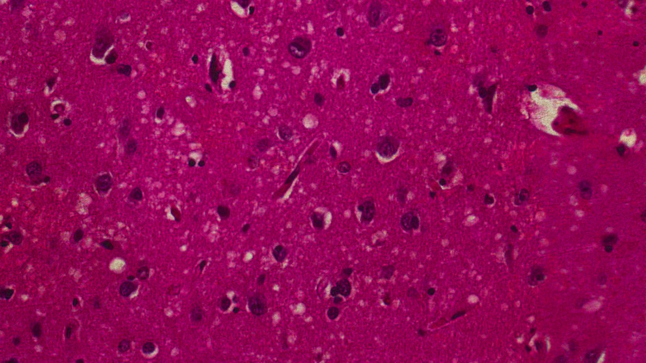 Характерна губчаста структура тканини мозку, ураженого пріонною інфекцією. DRdoubleB