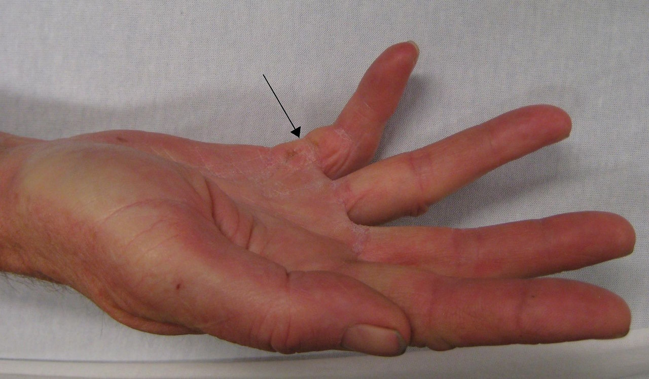 Хвороба Дюпюїтрена з ураженням правого мізинця руки. Стрілкою показано місце ущільнення сухожилля.&amp;nbsp;James Heilman, MD /&amp;nbsp;Wikimedia Commons