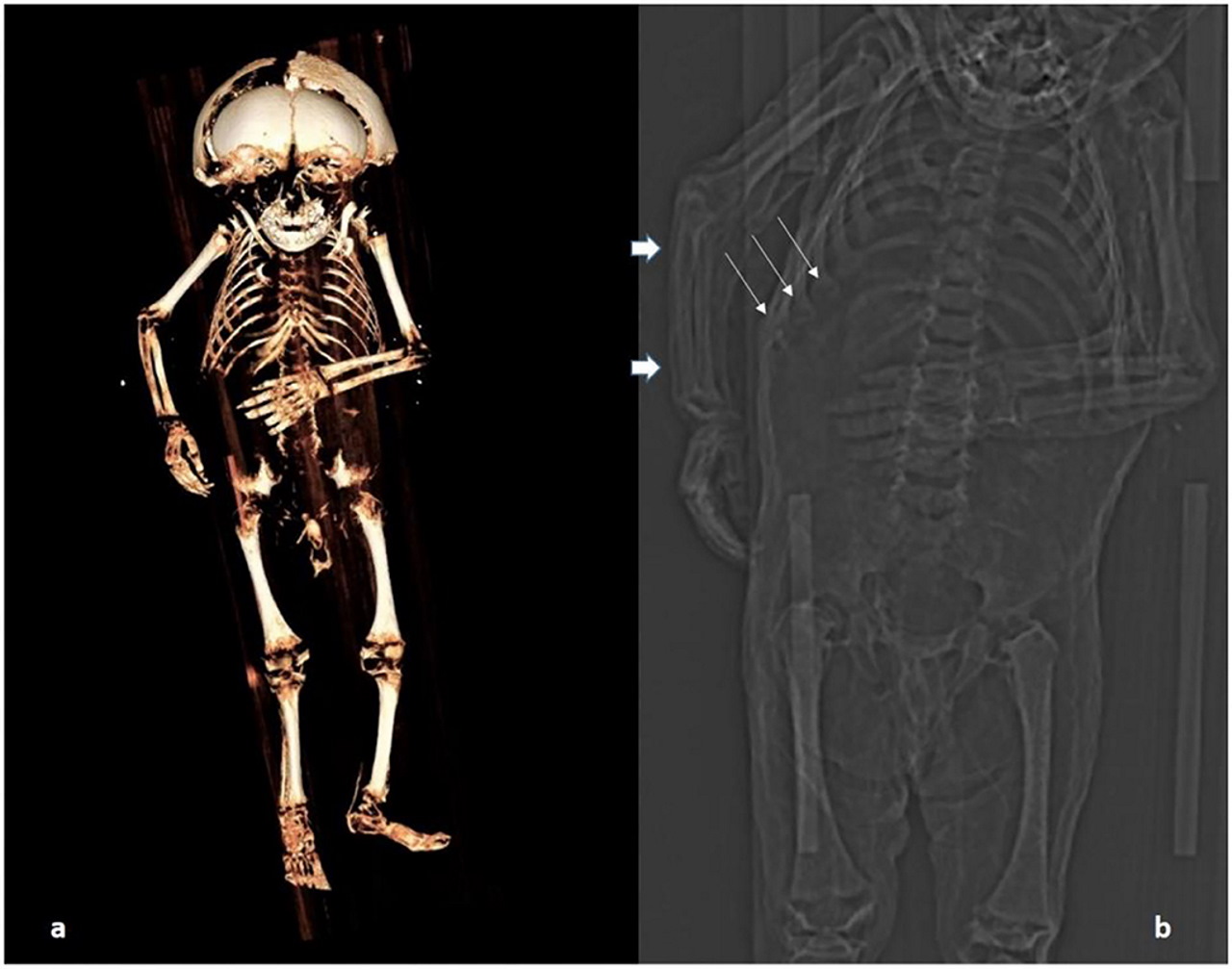 Скан скелету хлопчика із указанням деформації ребер.&amp;nbsp;Andreas Nerlich et al. / Frontiers in Medicine, 2022