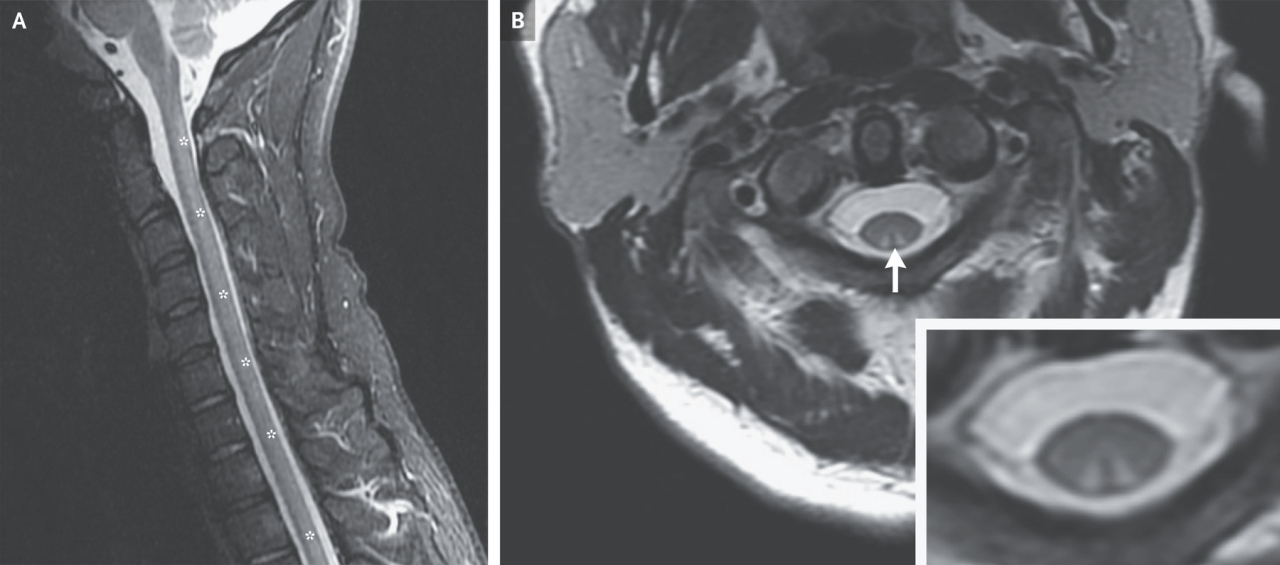 МРТ-зображення спинного мозку пацієнта після звеселяючого газу із указанням пошкодження.&amp;nbsp;Joseph Yoon, Joshua Klein / The New England Journal of Medicine, 2022