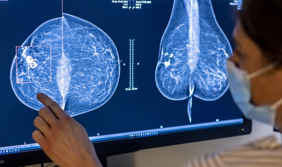 Засіб проти раку грудей зменшив ризик рецидиву у жінок без метастазів