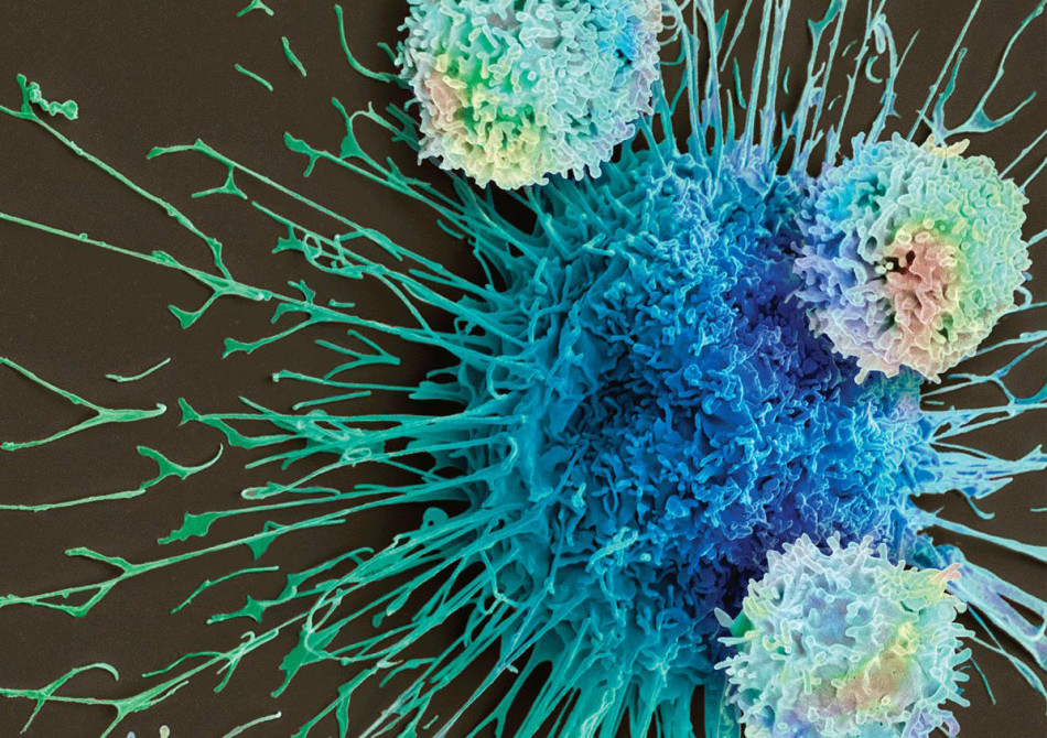 CAR-T-клітинну терапію раку запідозрили у спричиненні раку крові