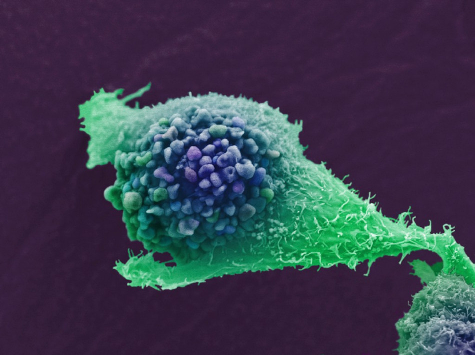 Комбінація двох препаратів знизила ризик смерті пацієнтів з раком простати на 40 відсотків. Вона була найефективнішою проти рецидивів