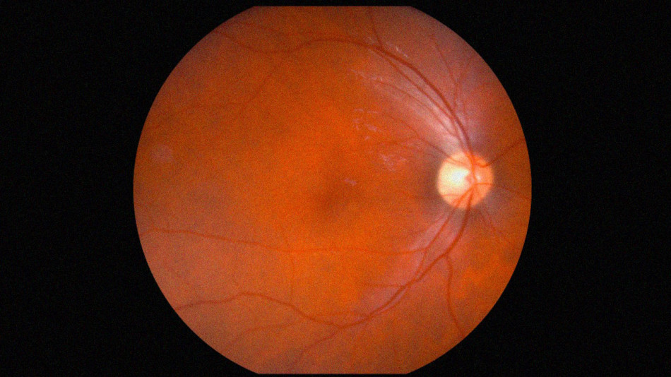 Сканування сітківки вказало на хвороби серця та старіння