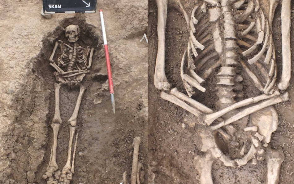 В Англії відкопали скелет середньовічного чоловіка, який пережив ампутацію руки