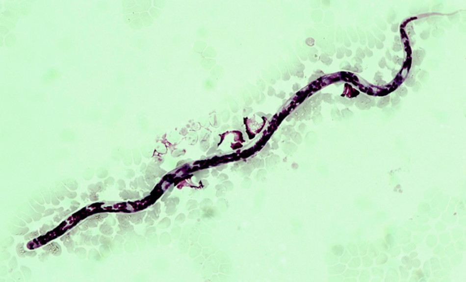 З ока молодої румунки дістали 11-сантиметрового собачого черва