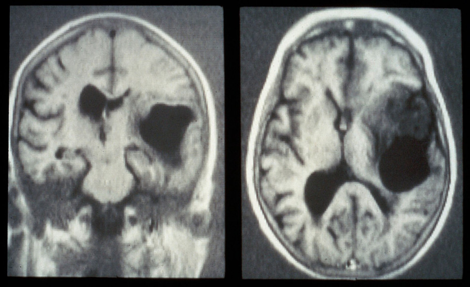 Носовий спрей з наночастинками поборов гліобластому в мишей. Він дозволить доставити ліки проти раку в людський мозок