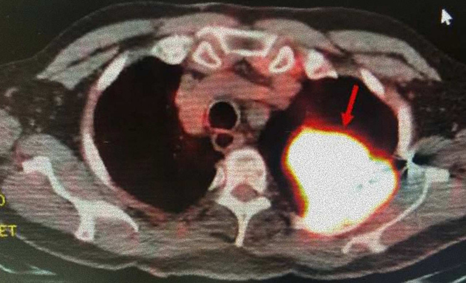 У літнього американця знайшли пухлину легень на місці старого кульового поранення