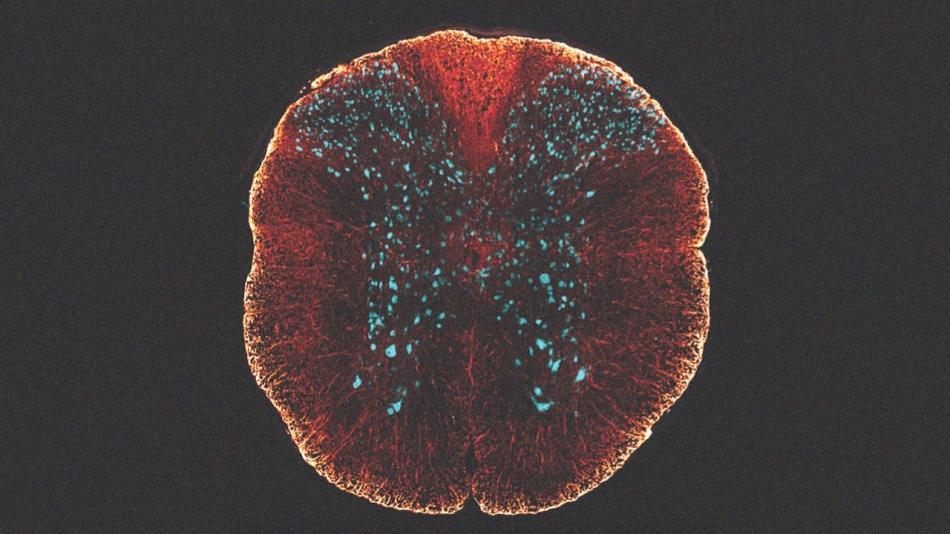 Генна терапія спінальної м’язової атрофії вперше допомогла дітям від двох років і підліткам