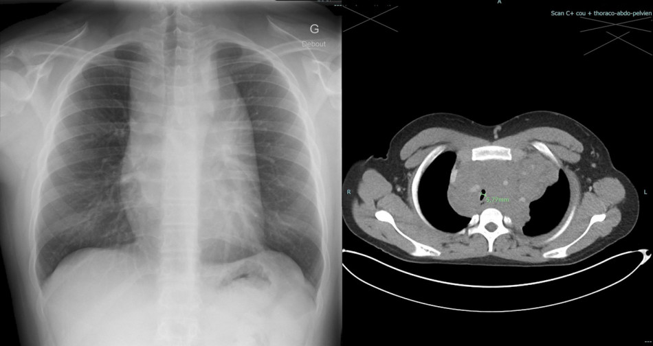 У канадського підлітка виявили рак завдяки взяттю зразків тканин під гіпнозом