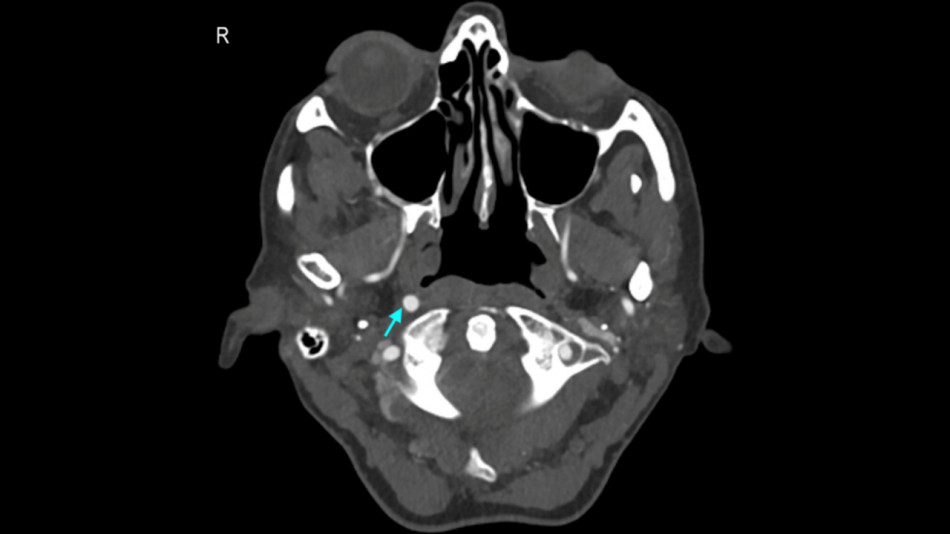 Інсульт допоміг виявити вроджену відсутність сонної артерії в літньої британки