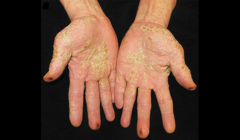 30 років куріння довели американця до гнійників на долонях. Їх вилікували без відмови від цигарок