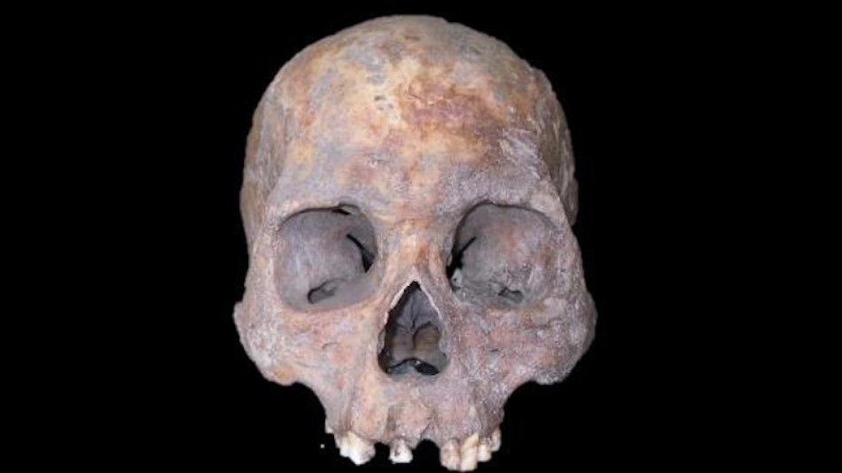 Рештки з Колумбії віком 5500 років вказали на поширення сифілісу з Америки