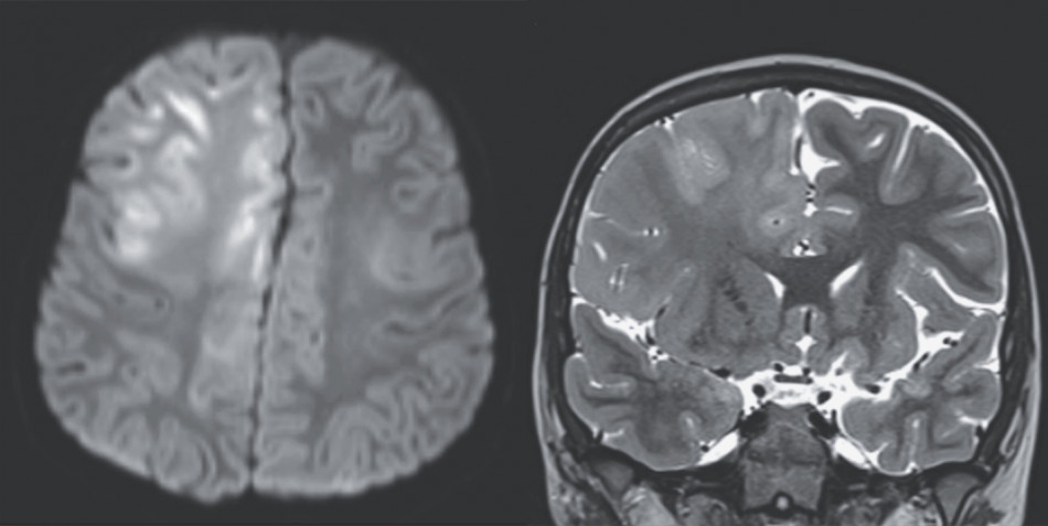 Семирічний хлопчик з Афганістану помер від спричиненого кором рідкісного запалення мозку