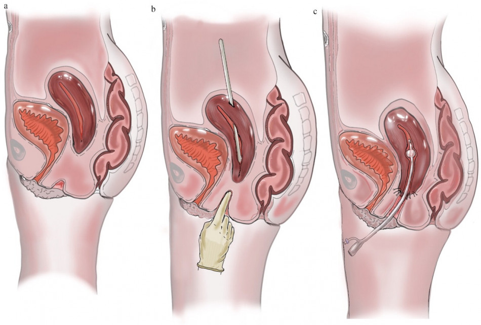 Британка без шийки матки та частини вагіни завагітніла природним шляхом і народила після операції