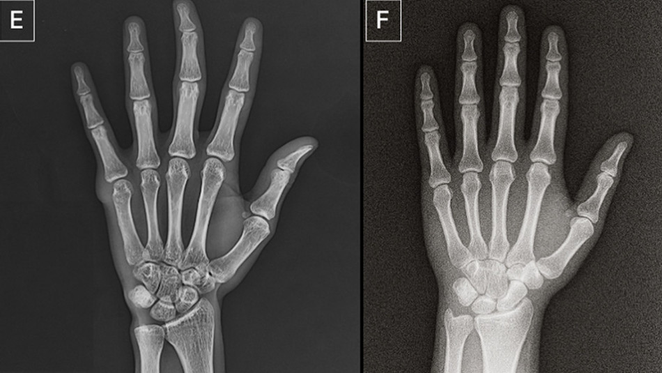Половина радіологів не відрізнила згенеровані ChatGPT рентген-знімки від справжніх. Штучний інтелект впорався не краще