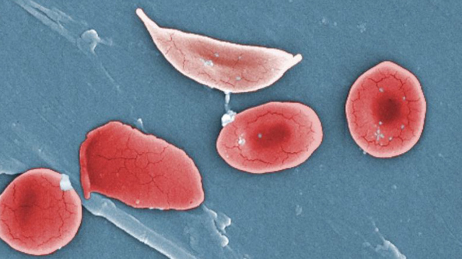 Нова генна терапія спадкової хвороби крові позбавила симптомів 27 із 28 пацієнтів. Попередня викликала пухлини