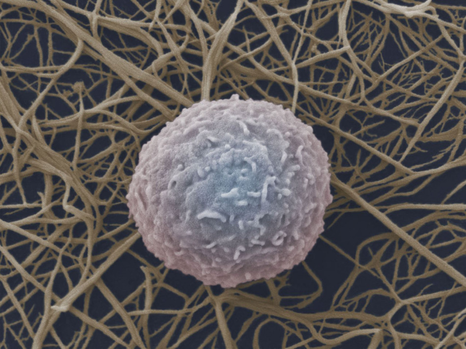 Клітинна терапія вперше позбавила пацієнтку одразу трьох автоімунних захворювань