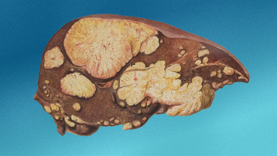 Пацієнти з пересадженою печінкою прожили понад три роки без ліків для пригнічення імунітету