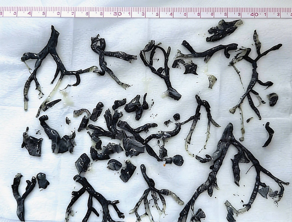 З легень китайця дістали копію його ж бронхів із сажі