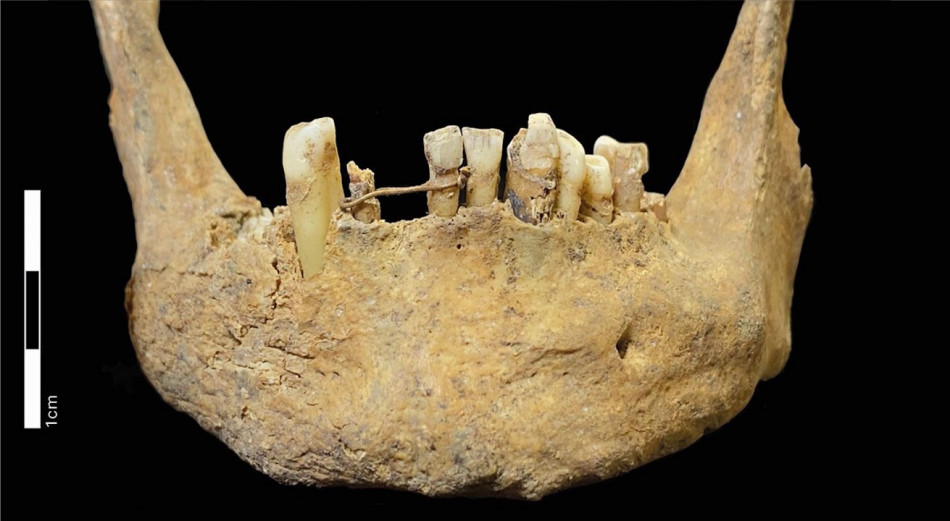 Шотландському багатію встановили золотий зубний місток за століття до появи стоматології